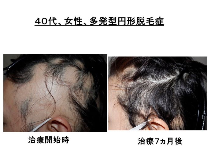 円形脱毛症　病院